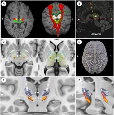 One-pass deep brain stimulation of subthalamic nucleus and ventral intermediate nucleus for levodopa-resistant tremor-dominant Parkinson’s disease